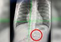 Airpods Tertelan, Bocah Ini Masuk IGD Tapi Berhasil Keluarkan Airpodsnya Sendiri tanpa Bantuan Dokter