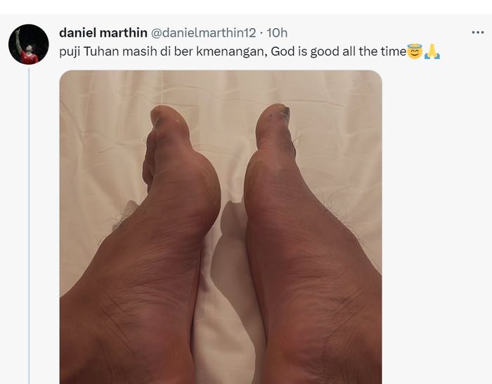 potret unggahan Daniel Marthin yang menunjukkan kakinya bengkak usai semifinal thailand Masters 2023
