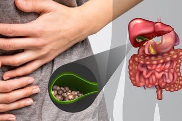 Pengidap batu empedu tidak boleh mengonsumsi makanan sembarangan.
