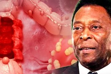 3 Bahaya Kanker Usus yang Bisa Dicegah, Seperti Diderita Legenda Sepak Bola Pele