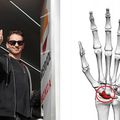 Alami Retak Tulang Skafoid, Jorge Lorenzo Harus Menjalani Operasi