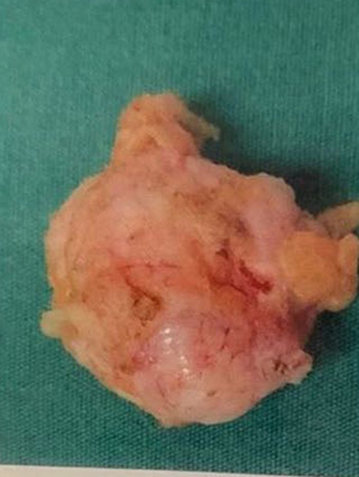 Tumor Payudara 