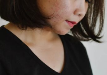Jangan Remehkan Stres! Selain Sebabkan Jerawat, Ternyata Juga Bisa Bikin Kulit Kamu Mendapatkan Masalah Lain