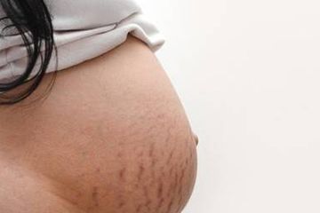 Menjadi salah satu ciri-ciri hamil, ini penyebab ibu hamil mengalami stretch mark