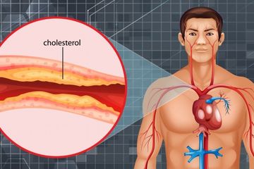 Penyandang Kolesterol Harus Batasi Konsumsi Makanan Satu Ini, Bisa Mematikan
