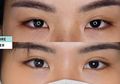 Treatment Double Eyelid, Standar Kecantikan Wanita Korea yang Diminati di Indonesia