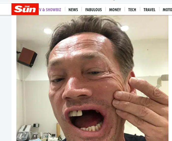Kondisi Sid Owen yang kehilangan 6 gigi akibat bermain golf