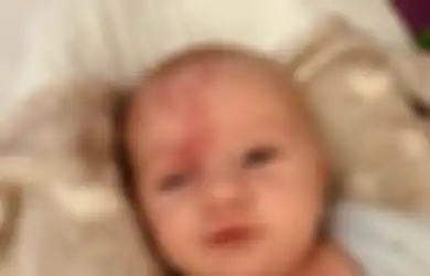 Bayi Ini Lahir Dengan Tanda Seperti 'Bekas Anggur' Di Wajahnya, Tidak Disangka Ternyata Menderita Sindrom Penyakit Langka Ini Sampai Mengalami Kejang Hampir Satu Jam