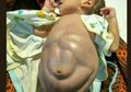 Bayi 4 Bulan Diberi Makan Nasi Perutnya Membesar dan Bentuknya Mengerikan, Sangsi Bagi Orangtua Denda 100 juta Kurungan 1 Tahun