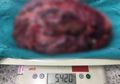 Mengeluh Sakit Perut yang Sangat Mencekam, Ternyata di Perut Pria Ini Ditemukan Tumor yang Beratnya Hampir Mencapai 6 Kilogram