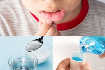 Rekomendasi Obat Kumur Sariawan Pada Anak dari Bahan Alami Hingga Tersedia di Apotek