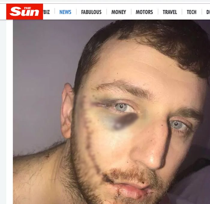 Wajah penuh jahitan  Jay Burns, fans yang terluka akibat tawuran saat laga Everton vs Millwall