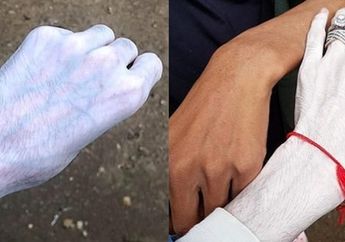 Terobsesi Punya Kulit Putih, Orang-orang ini Dapatkan Hasil yang Lebih Mengerikan dari Zombie