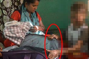 Kasihan, Remaja Malang 16 Tahun Ini Oleh Orangtuanya Disebut Mirip Ular, Kulitnya Bersisik dan Setiap 6 Minggu Ganti Kulit