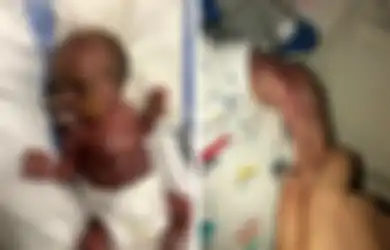 Terlahir Tanpa Kulit dan Digambarkan Seperti 'Daging Mentah', Bayi Ini Secara Ajaib Bisa Bertahan Hidup