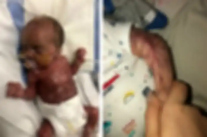 Seorang bayi yang terlahir tanpa kulit melapisi tubuhnya telah menentang kemungkinan terburuk, ia bisa bertahan secara ajaib.