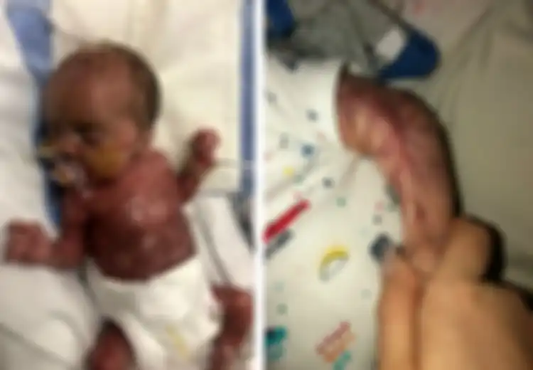 Terlahir Tanpa Kulit dan Digambarkan Seperti 'Daging Mentah', Bayi Ini Secara Ajaib Bisa Bertahan Hidup