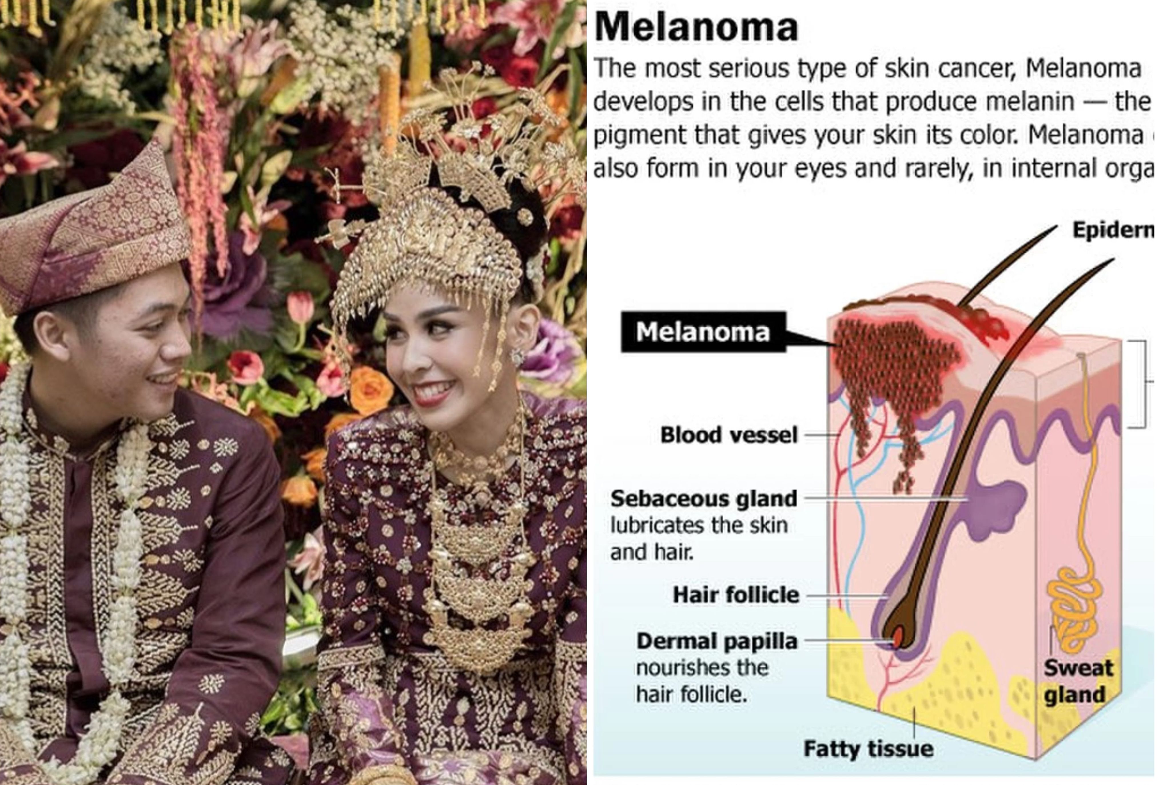Berita Adara Taista Terbaru Hari Ini Tidak Ribet Ini Cara Sederhana untuk Mencegah Kanker Melanoma yang Menyerang Adara Taista Berita Adara Taista Terbaru Hari Ini Tidak Ribet Ini Cara Sederhana untuk Mencegah Kanker Melanoma yang Menyerang Adara Taista