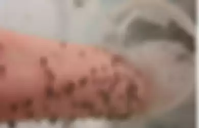 Seorang ilmuwan merelakan tangannya disantap ribuan nyamuk.
