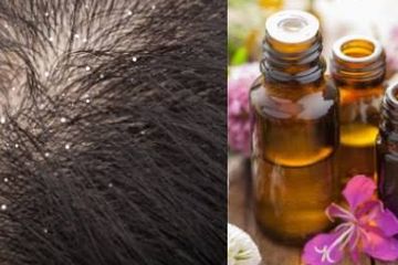 Cara Menghilangkan Ketombe Dengan Minyak Lavender, Apakah Aman?