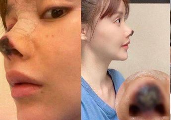 Gak Nyangka! Dulu Viral Hidung Gosong Gara-gara Gagal Operasi Plastik, Penampilan Artis ini Setahun Kemudian Tak Terduga! Dijamin Bikin Melongo
