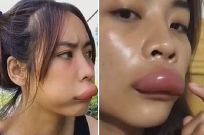 Kena Cium Pantat Lebah Bibir Cewek Ini Langsung Bengkak Segede Sosis Semua Halaman Hai