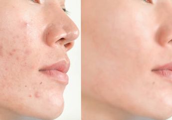 Bertahun-tahun Bekas Jerawat Susah Hilang, Rahasianya Ternyata Cuma Semprot Pakai Air Kelapa, Skincare Bisa Kalah Saing!