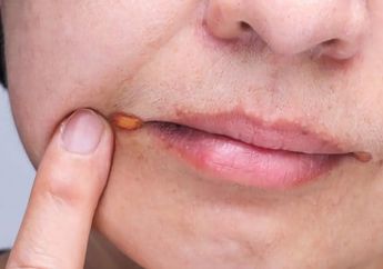 Atasi Peradangan Pada Sudut Bibir dengan Obat Rumahan Ini