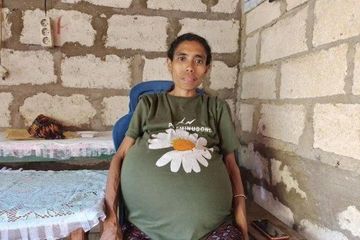 Kitsa Seberat 20 Kilogram ada di Dalam Perut Wanita Ini Selama 15 Tahun
