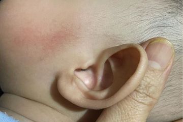 Cara membersihkan kotoran telinga anak
