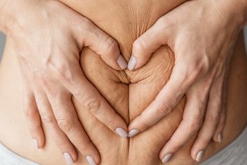 Perbedaan stretch mark dan selulit