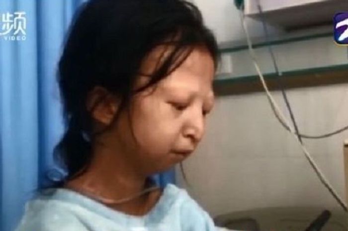 Wu Huayan, gadis 24 tahun yang meninggal dalam kondisi kurang gizi karena hanya makan nasi dan sambal saja.