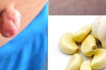 Kali Ini Jangan Gunakan Bawang Putih Sebagai Obat Alami, Khususnya Pada Kutil Kelamin, Ini Alasannya