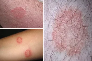 Apakah kurap bisa sembuh sendiri? Ternyata segini lamanya!