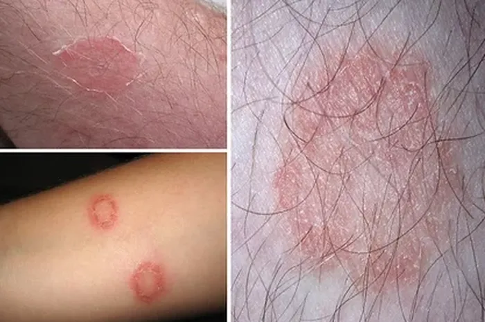 Apakah Kurap Bisa Sembuh Sendiri Tanpa Diobati? Bisa Tapi Lama Banget