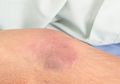 Kulit Membiru Bisa Jadi Kondisi Gawat Darurat Sianosis, Begini Penanganannya
