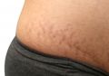 Bukan Cuma Baking Soda, Pengobatan Sederhana Ini Nyatanya Ampuh Hilangkan Stretch Mark Tanpa Habiskan Banyak Uang