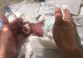 7 Langkah Praktis Merawat Bayi Prematur, Anti Ribet dan Takut Salah