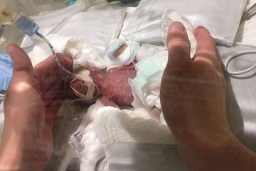 7 cara mudah meeawat bayi prematur, jangan takut!