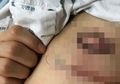 Inne Firmawati di Cibinong Mengalami Infeksi Pada Jahitan Operasi Sesar, Aldi asal Malang Kakinya Membusuk Usai Operasi Patah Tulang, Infeksi Luka Operasi (SSI) Bisa Dicegah