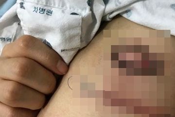 Inne Firmawati di Cibinong Mengalami Infeksi Pada Jahitan Operasi Sesar, Aldi asal Malang Kakinya Membusuk Usai Operasi Patah Tulang, Infeksi Luka Operasi (SSI) Bisa Dicegah