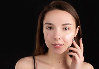 Cara Ampuh Memperbaiki Skin Barrier Wajah Akibat Jerawat, Yuk Ikuti