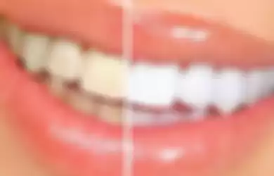 Kunyit bisa dipakai untuk atasi gigi kuning.