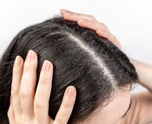 Tips Jitu Menghilangkan Ketombe yang Bikin Rambut Gatal, Cukup Gunakan Bahan-bahan Alami Ini