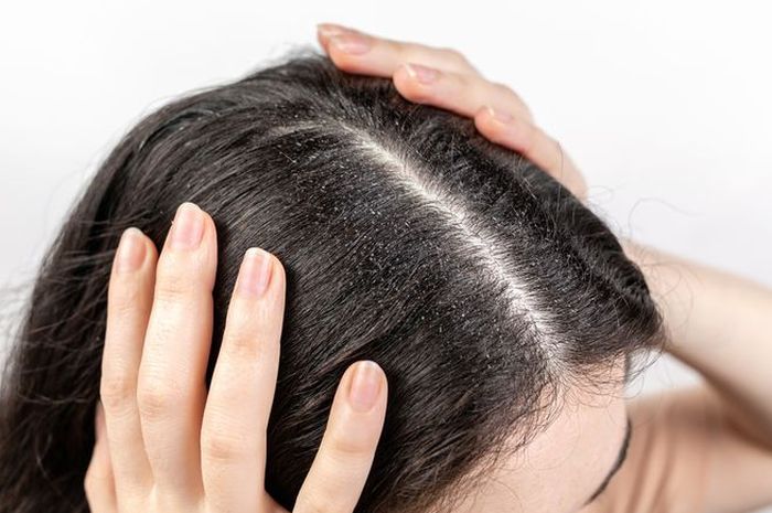 Tips jitu menghilangkan ketombe yang menganggu rambut