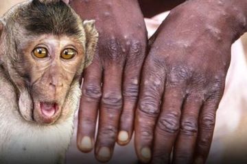 Sebelum Dinyatakan Positif Cacar Monyet, Inilah 5 Golongan Status Penderita Dalam Surveilans Kesehatan