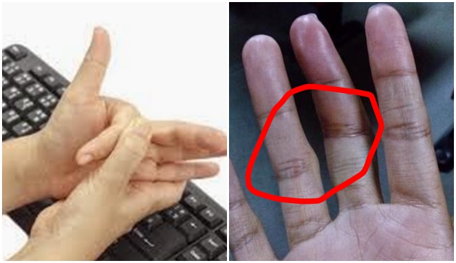Jangan biasakan kretek-kretek jari alias membunyikan persendian jari, berbahaya.